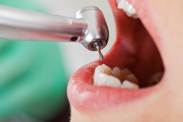 Best Emergency Tooth Extraction in Altamont, TN